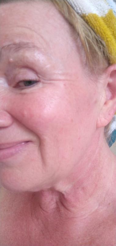 Really deep lines, before using this cream!