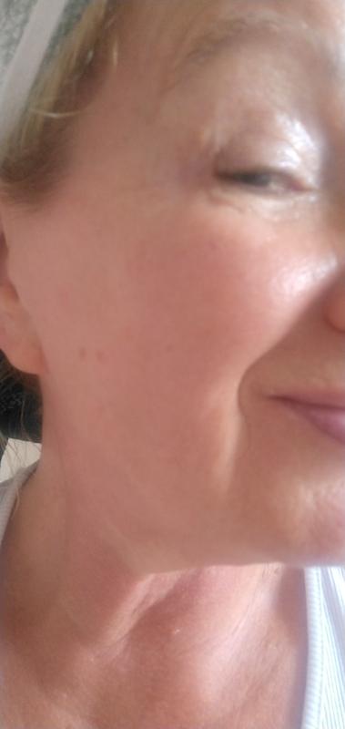 After 4 weeks! So much improvement, noticeably less deep!