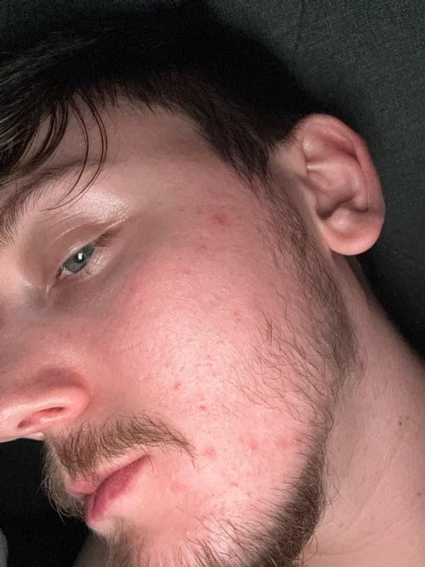 Customer photo for "Key to perfect skin"