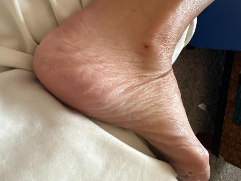 Caused sore on ankle