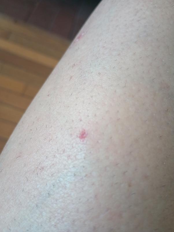 Welts from line projectile