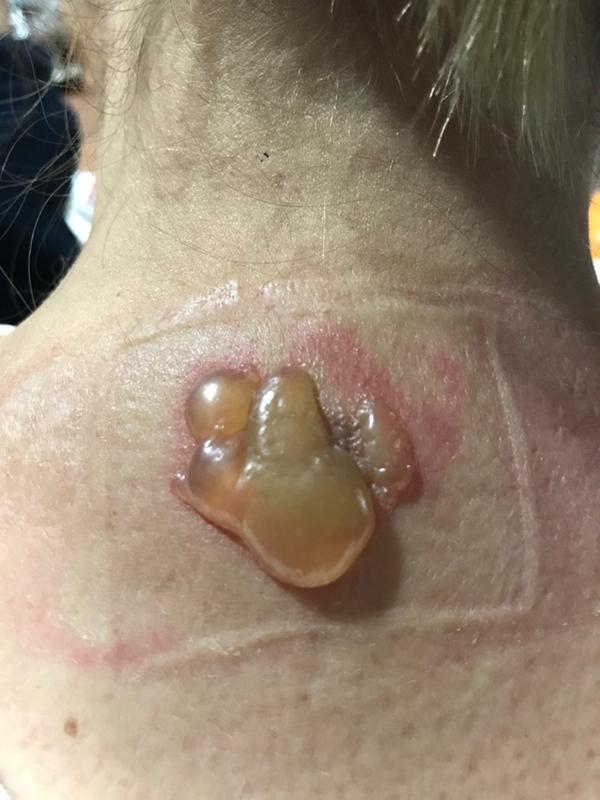 Check this out!! It hurts like crazy!! And it was from this heating pad!! Never again will I own one!!!