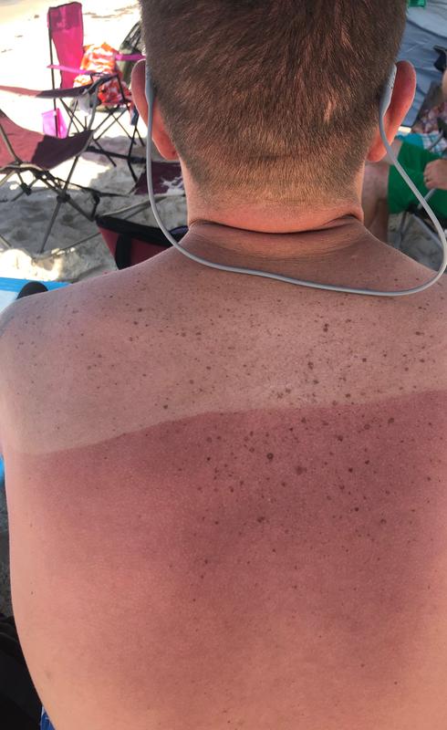 My husband  rubbed sunbum 70 just across his shoulders... his results a couple hours later.