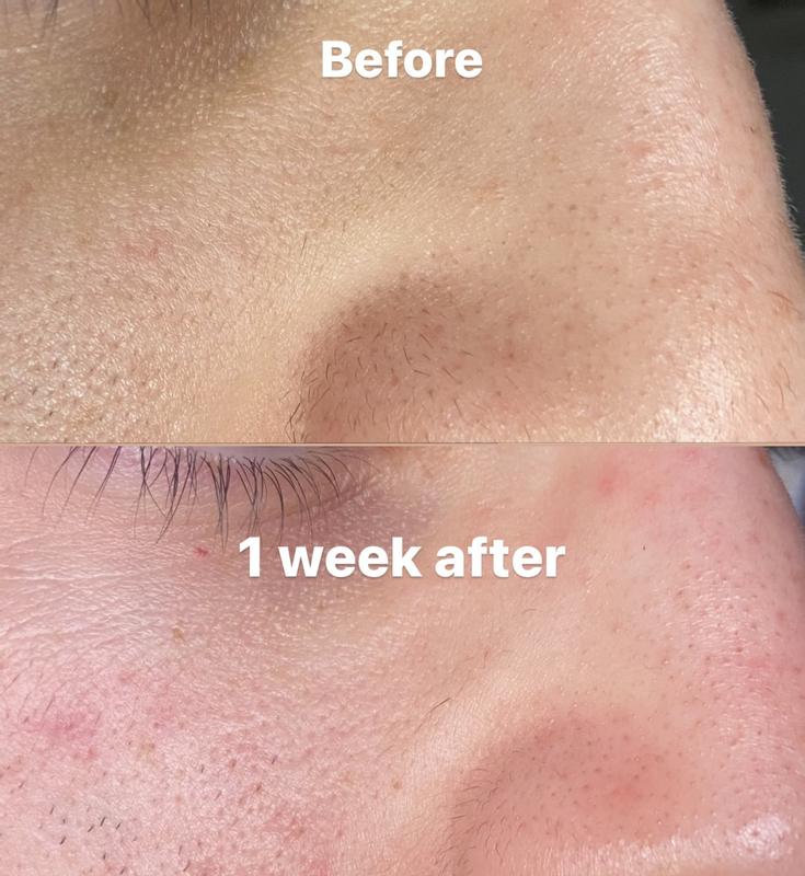 nose skin and blackheads