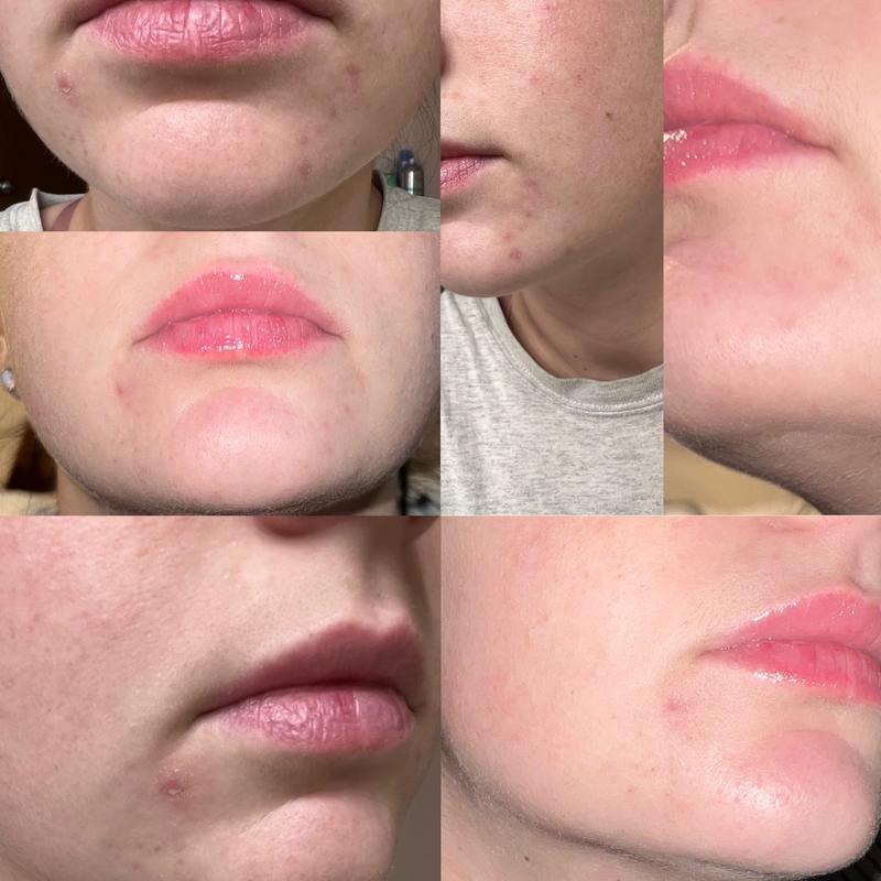 Less than a week no new breakouts and healing old. Pores smaller skin tighter