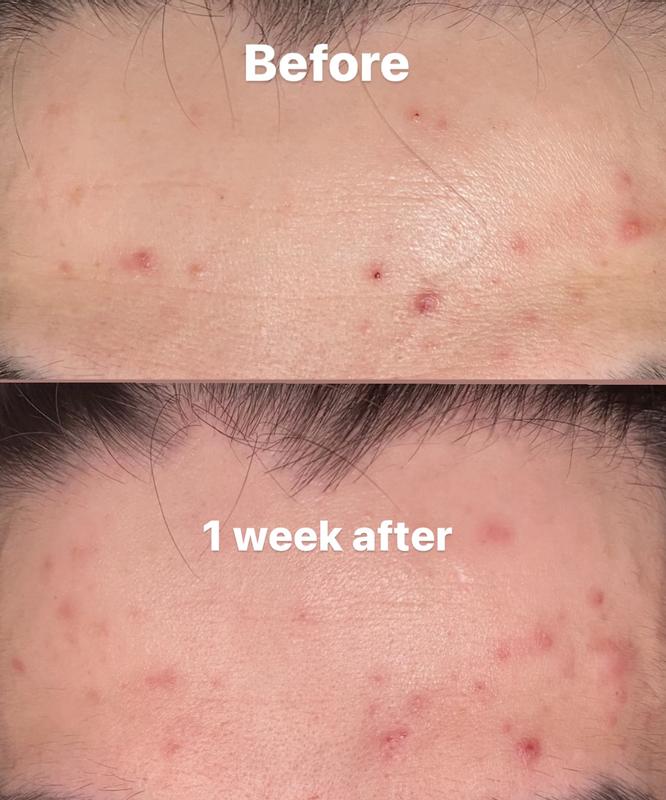 forehead and acne