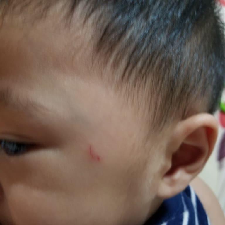 The scratch after the swelling went down