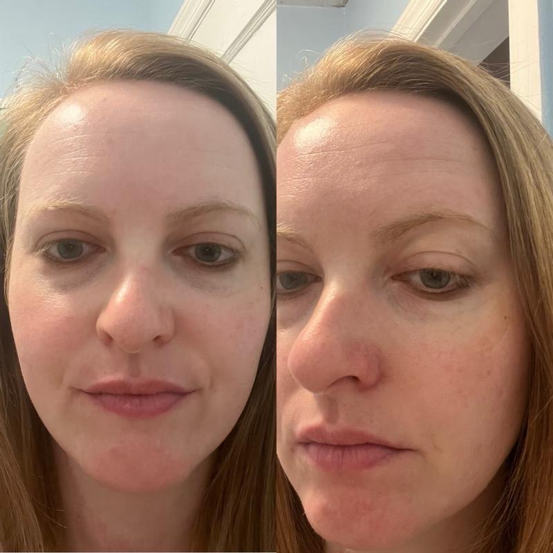 Customer photo for "Anti aging microneedle patches"