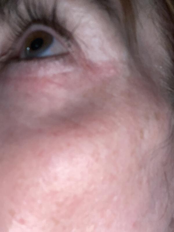 Customer photo for "Beware: pulled, raw skin"