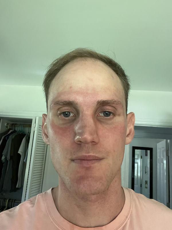 After 5 minutes of hydration