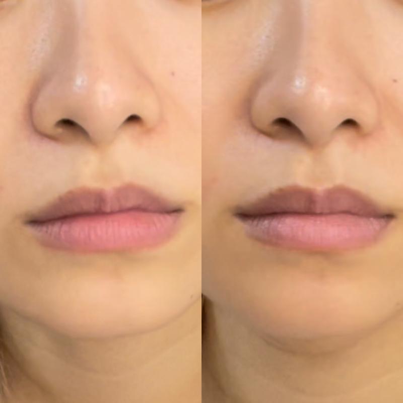 Before and after