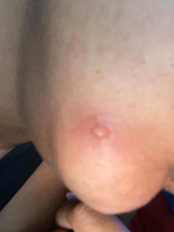 Literally took my skin off