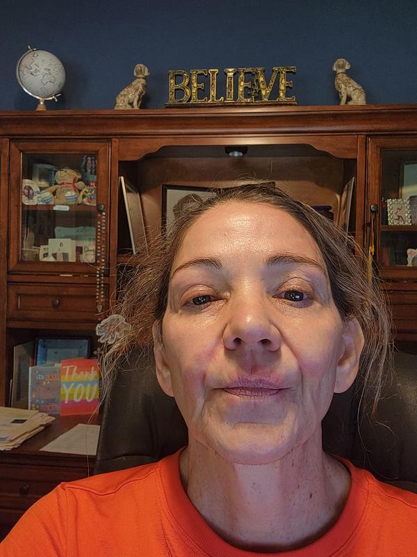Customer photo for "Bad Skin burn reaction"