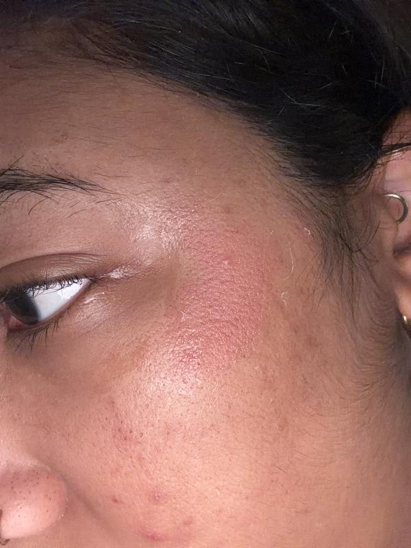 Day after application (i have burn gel on it)