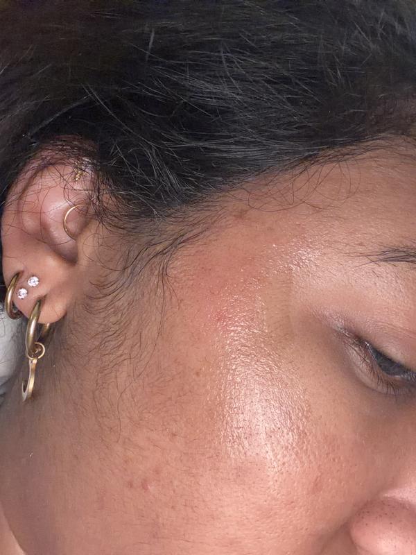 Day after application (i have burn gel on it)