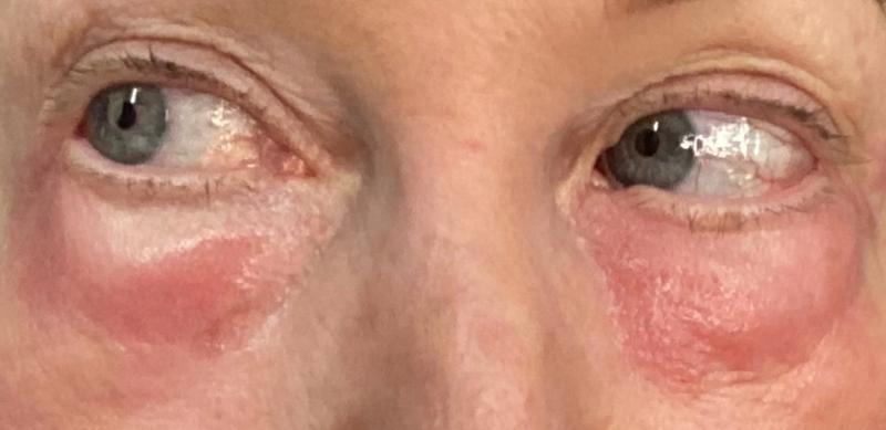 I have a coat of aquafor on them, so you can’t see the flakiness.