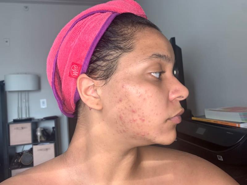 The first week of taking the acne relief kit May 11th