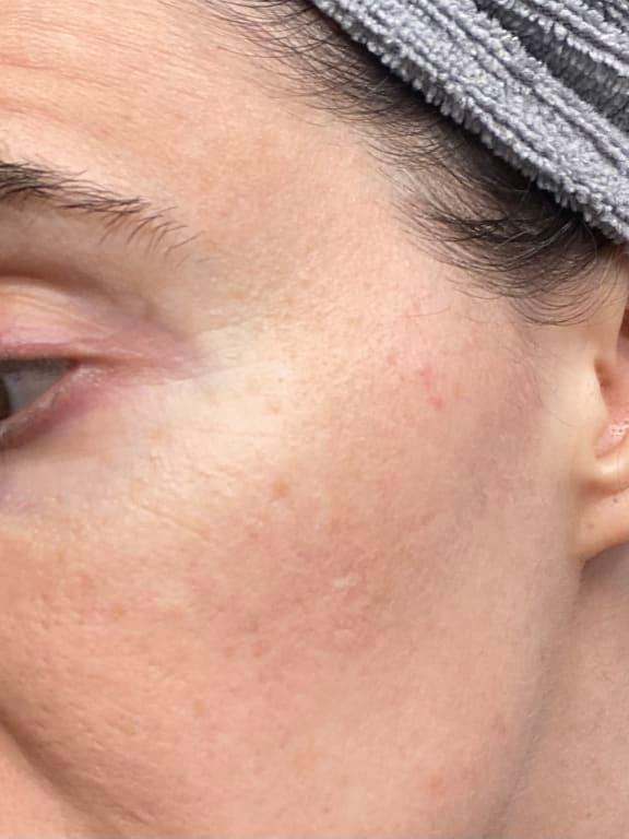 Close up of spots and scars that stayed. After treatment.