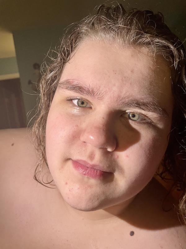 After one use of Perricone MD acne relief clay mask