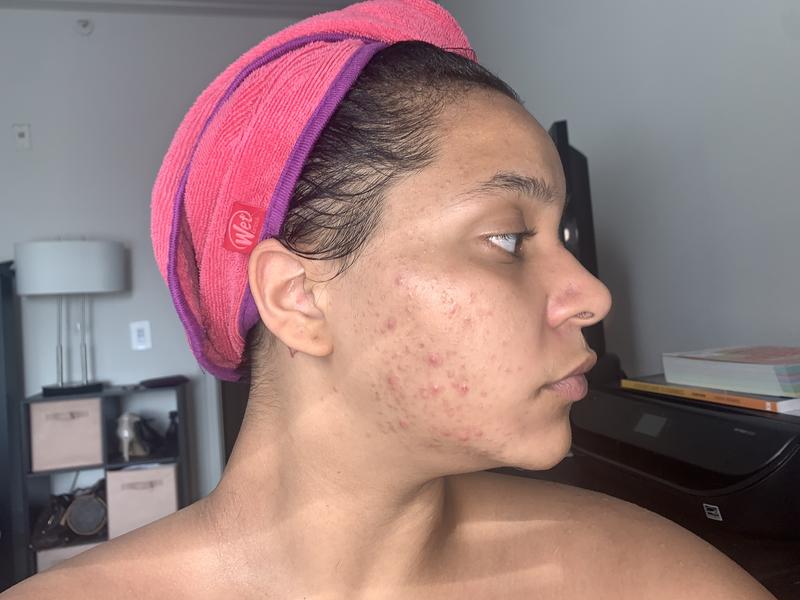 The first week of taking the acne relief kit May 11th