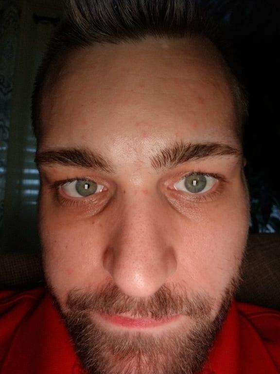 Caused ridiculous blemishes