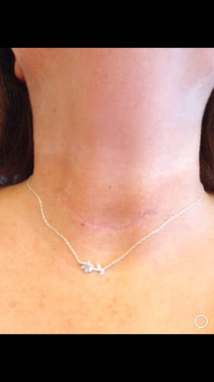 ONLY 3 weeks use, compare to the pic above (ropey scar)