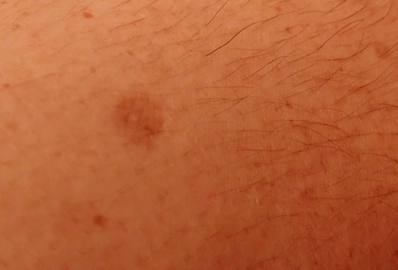 One on my arm for darker