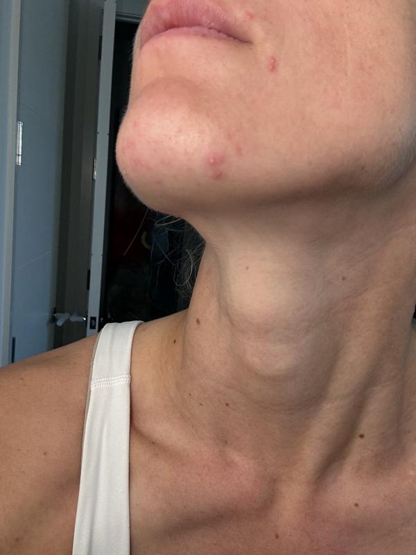 Customer photo for "Caused me to break out"