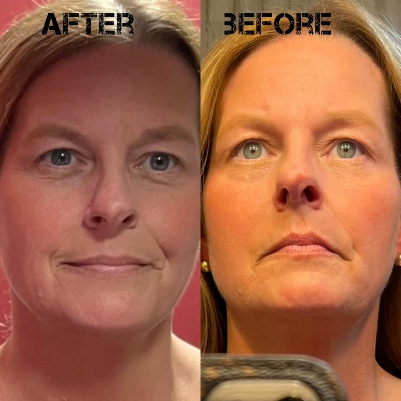 Roc Deep Wrinkle Filler Before And After Pictures