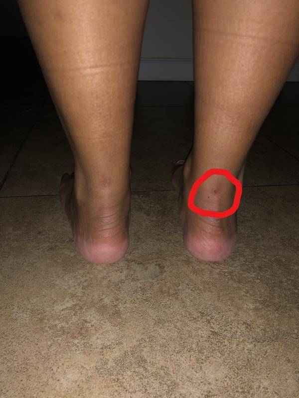 small scab that I got from a week of wear