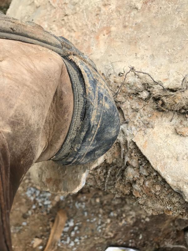 Toe separation repair left