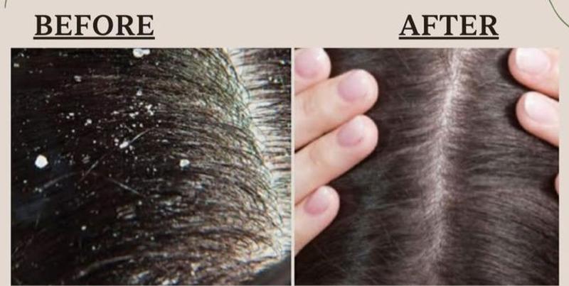 Dandruff free
