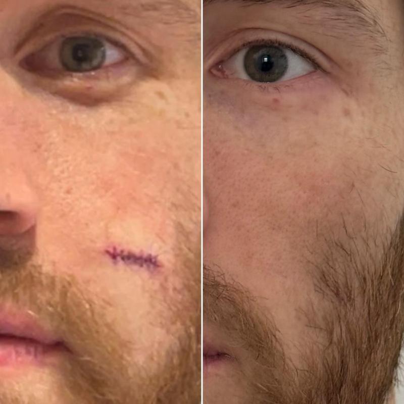Customer photo for "Game changer for scars"