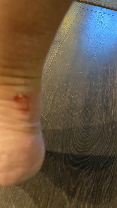 Blister from no show socks