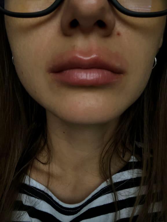 Customer photo for "Terrible Allergic reaction!"
