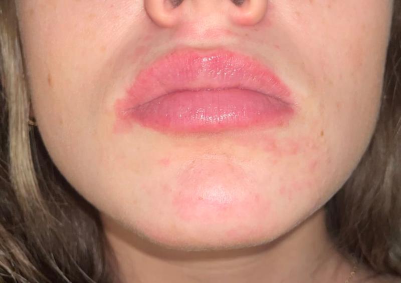 Rash that appeared after using ONE SWI