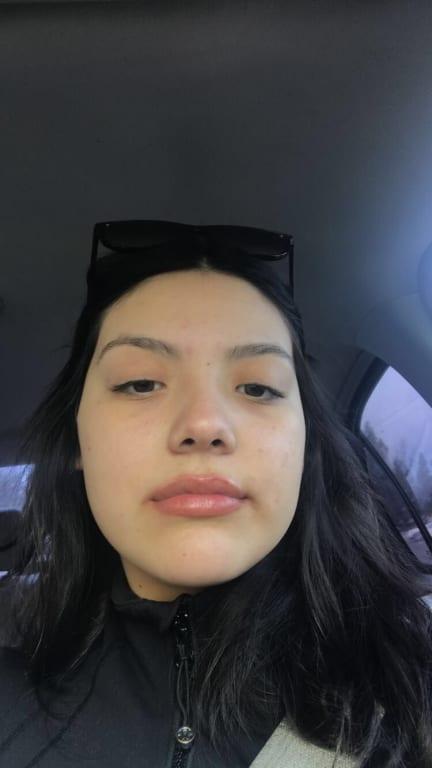 With lip injections+lip injections extreme
