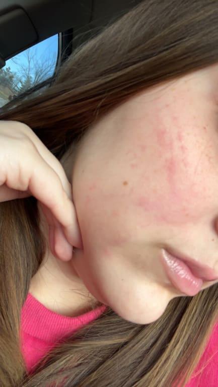 Horrible gives me rash everytime I put lipgloss on