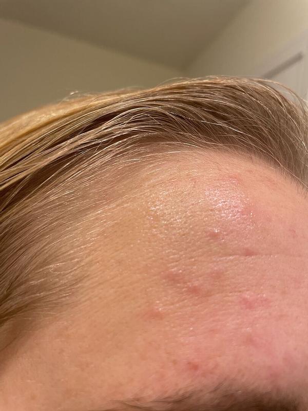 Customer photo for "Acne"