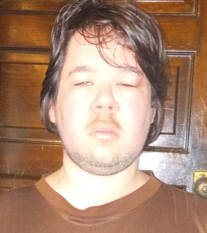 Face so swollen he can barely open his eyes