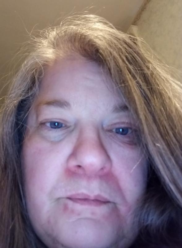 Face puffy and really swollen up and puffy eyes, with the right eye having a really red, swollen lump under it