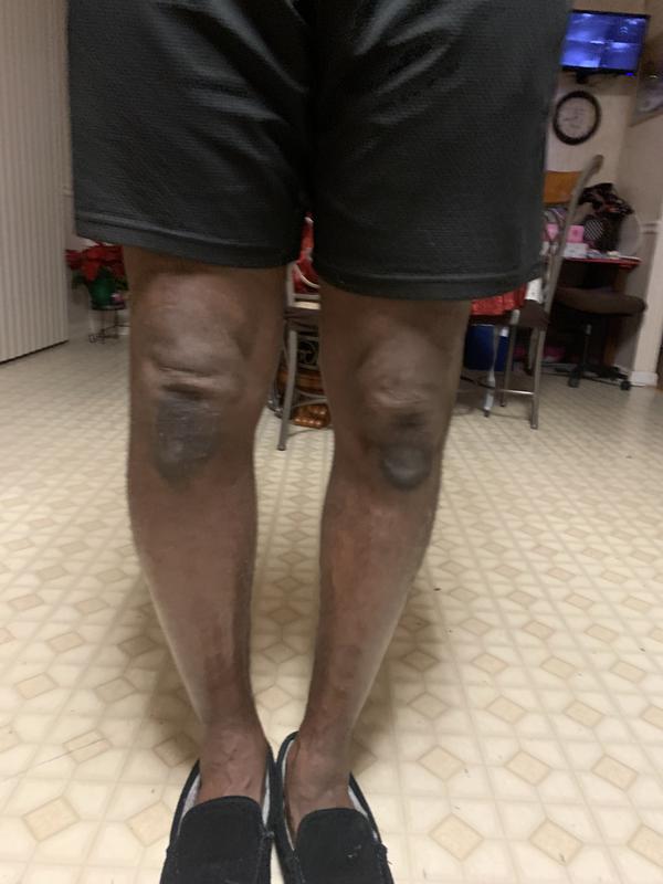 Even applied it to my swollen right lower leg. Back to normal in four days.