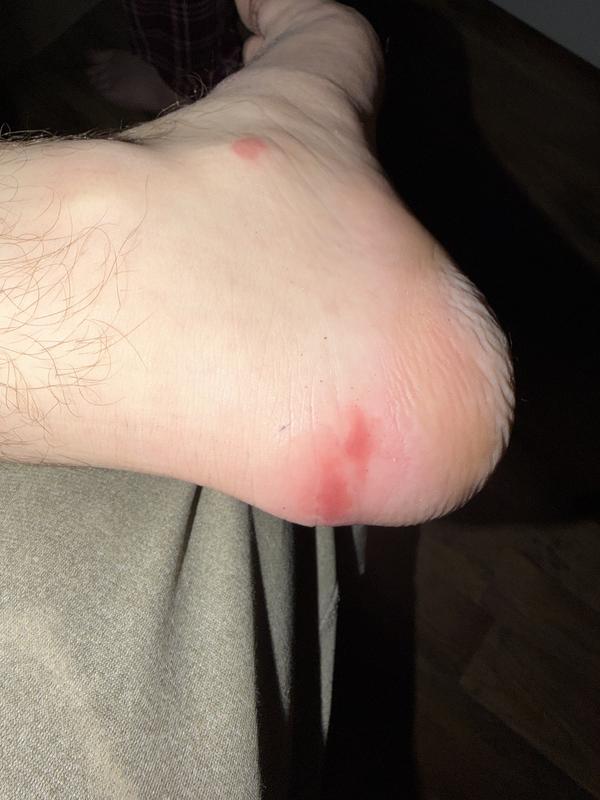 Damage on my feet from boots