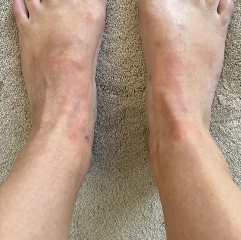 Boots caused an allergic reaction!