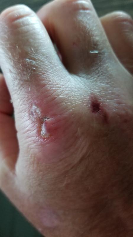 Auger got stuck, jammed knuckles into fence