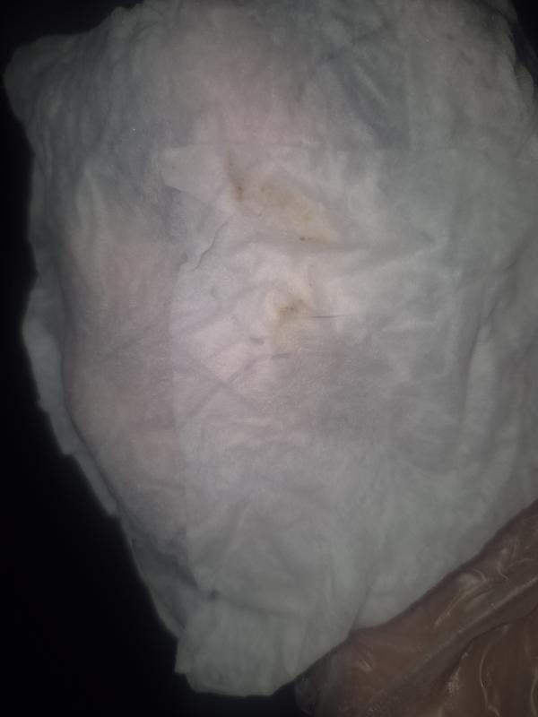 This is the tiny amount of drainage that I get after 8 days of treatment. Day one the whole wipe was covered in brown drainage.