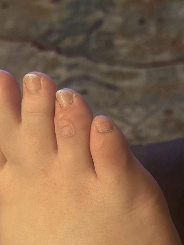 Customer photo for "Super disappointed- Caused horrible blisters"