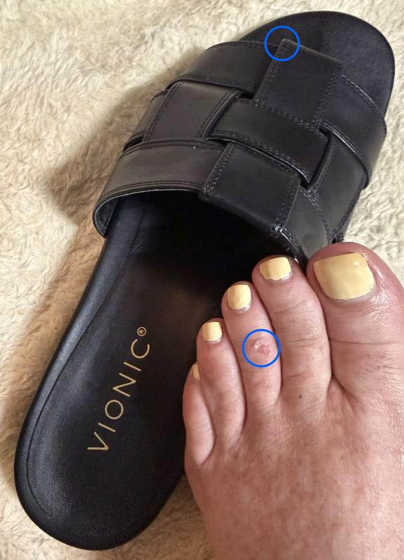 Caused blister