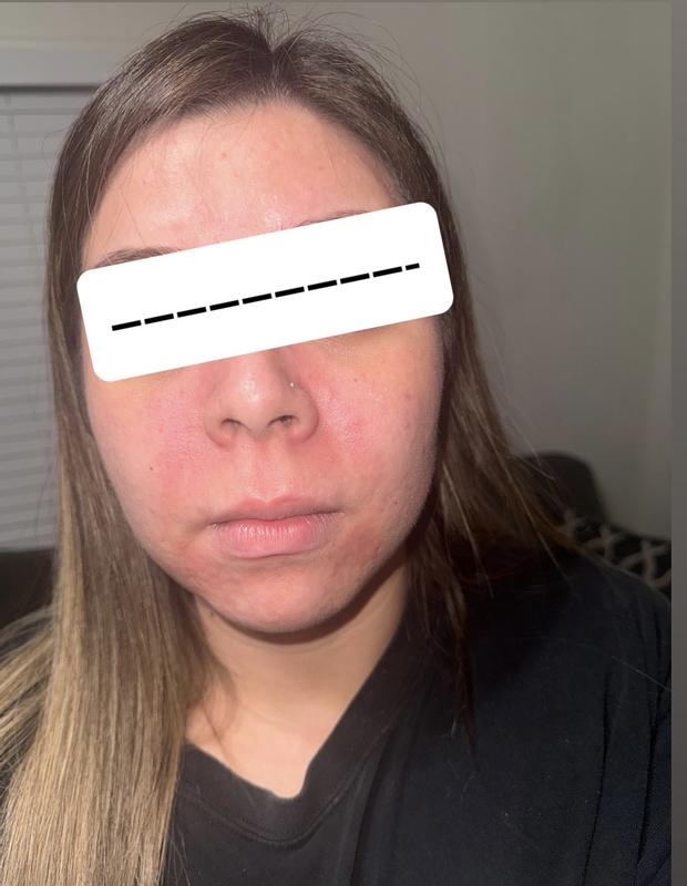 Customer photo for "Left My Face Red and Burning"