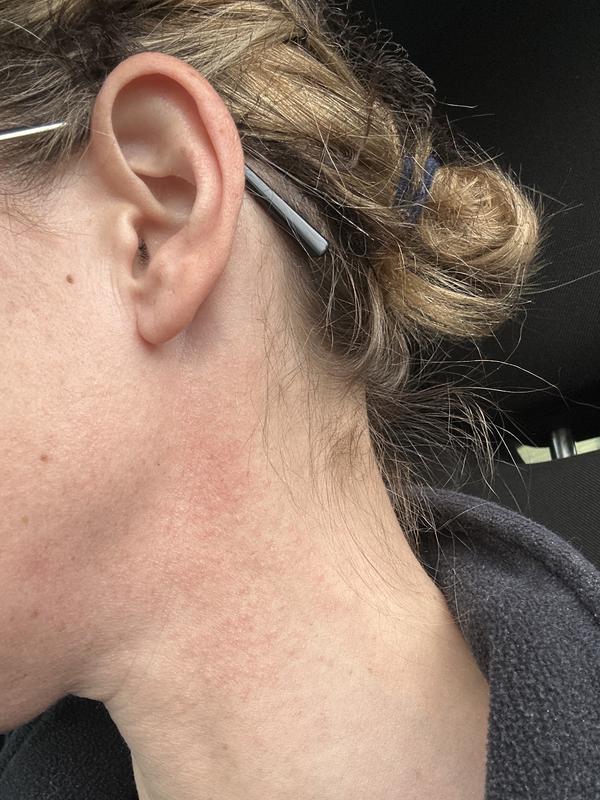Customer photo for "Severe allergic reaction"